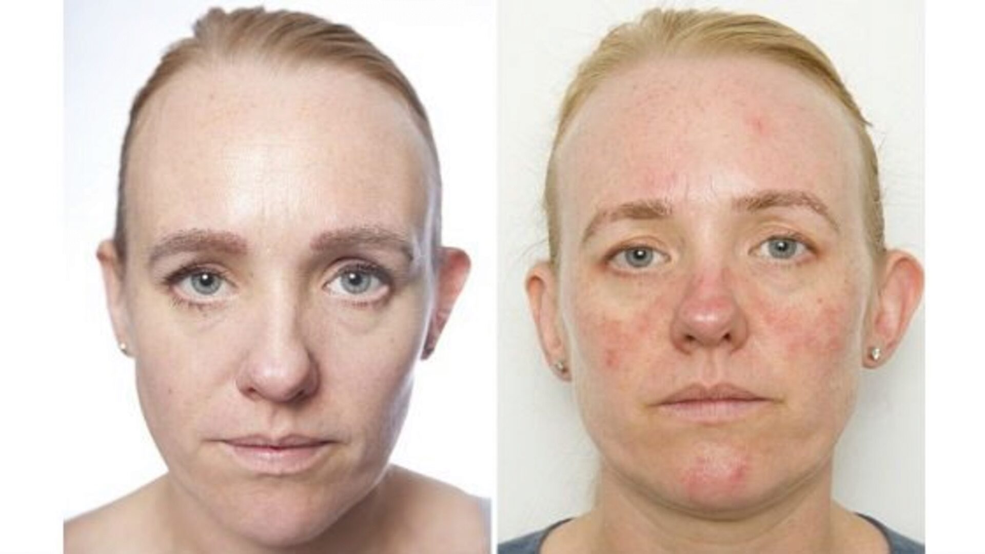 The biological age of Anna’s skin increased by 10 years