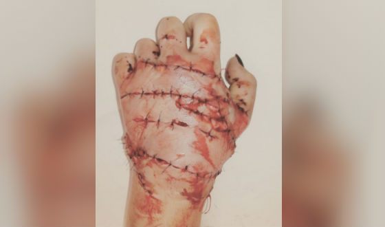 Doctors saved woman's hands amputated by axe