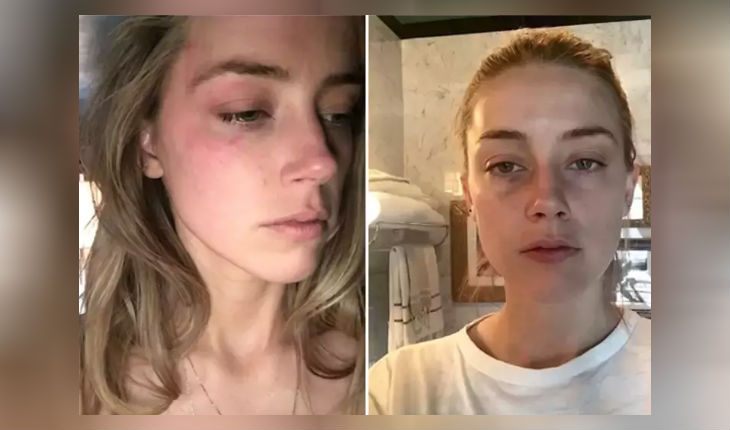 Amber Heard's bruises