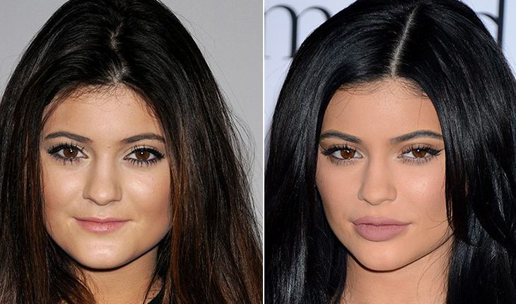 Kylie Jenner before and after plastic surgery