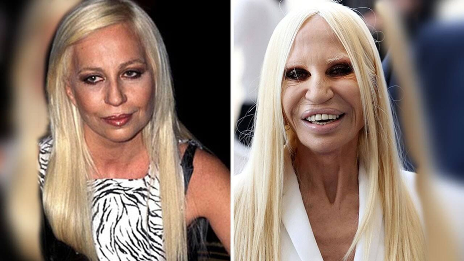 Donatella Versace Before and After Plastic Surgery