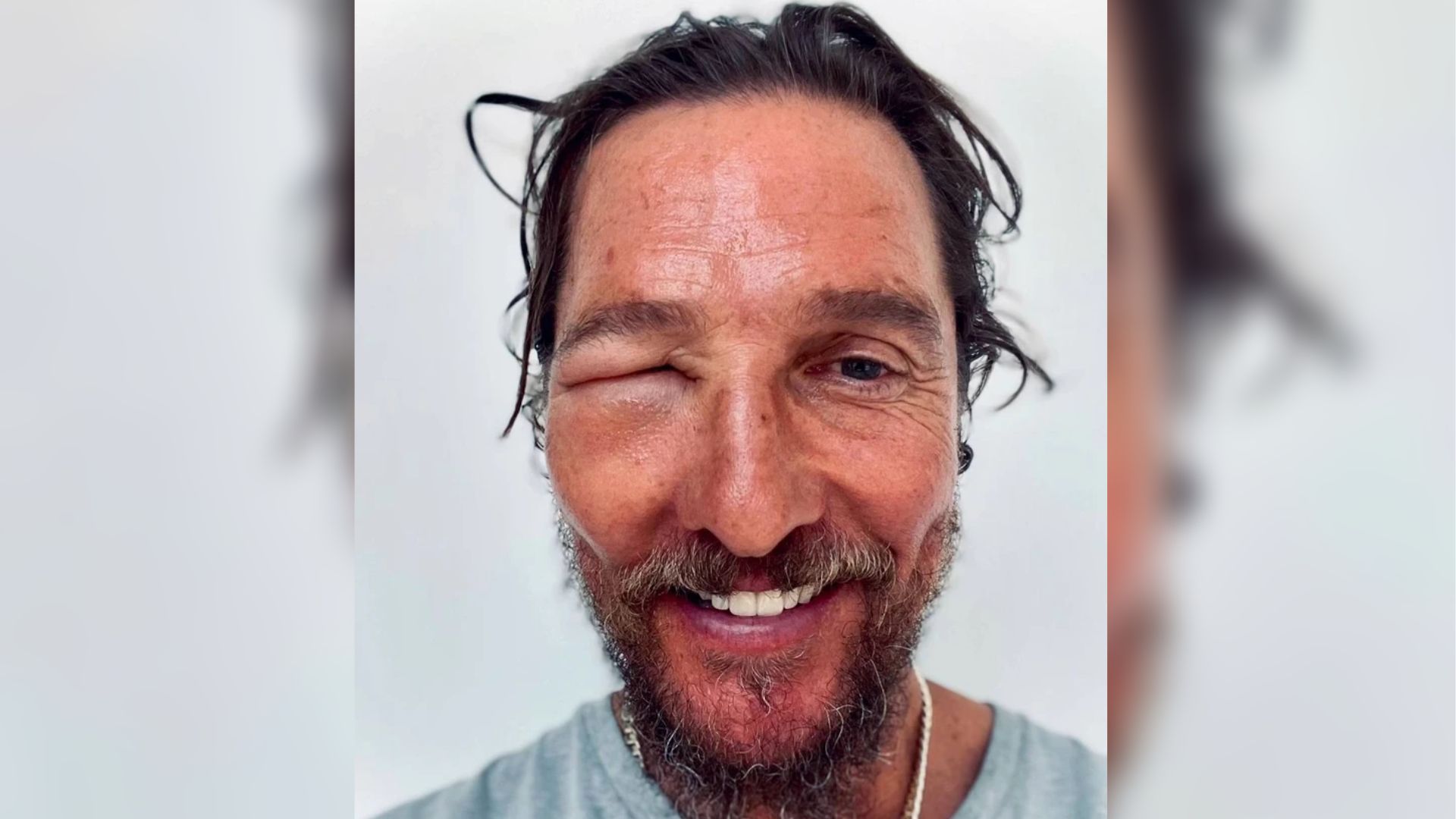 Matthew McConaughey after a bee sting