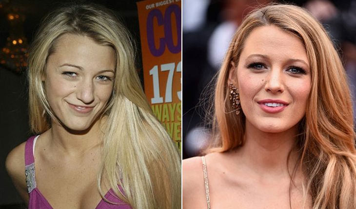 Blake Lively before and after plasty
