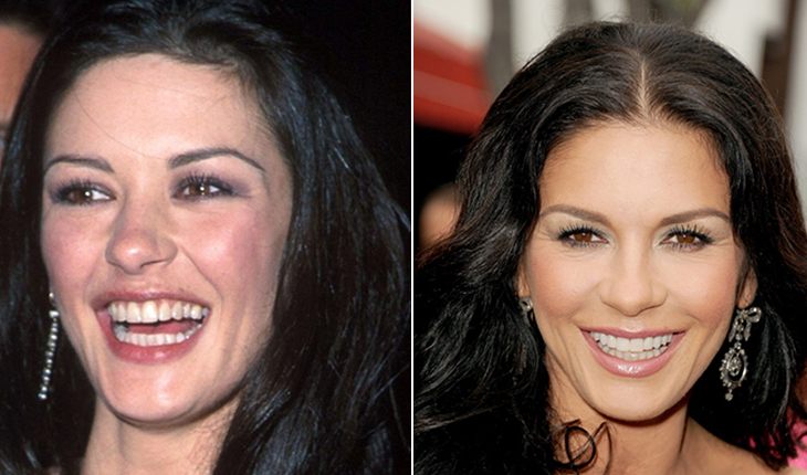Catherine Zeta-Jones before and after plastics