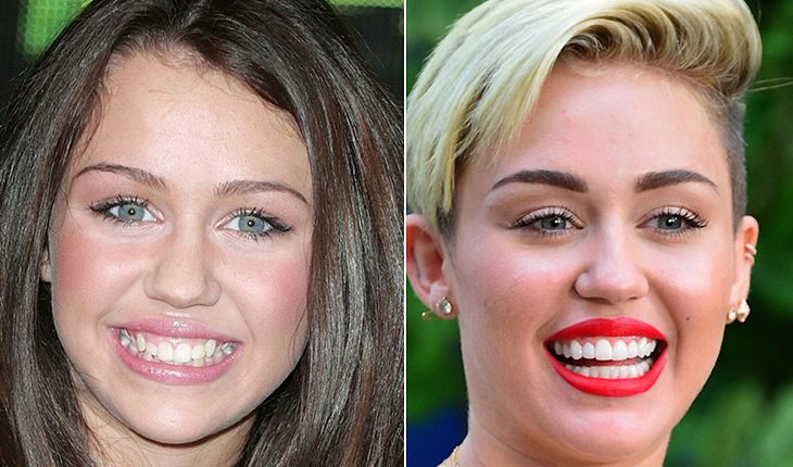 Miley Cyrus before and after plasty