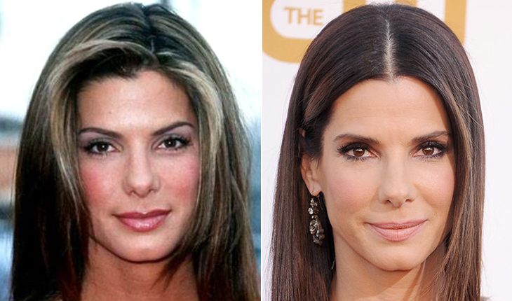 Sandra Bullock before and after plasty