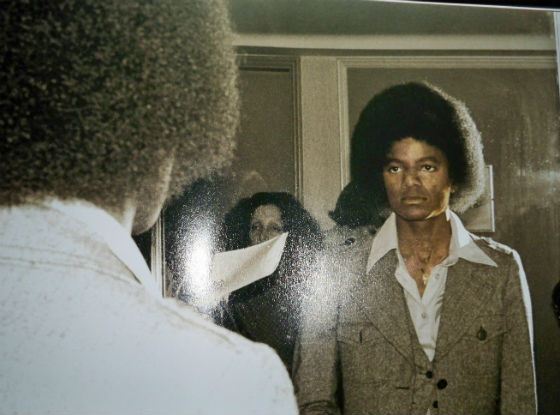Vitiligo manifested itself when Michael Jackson was in his youth